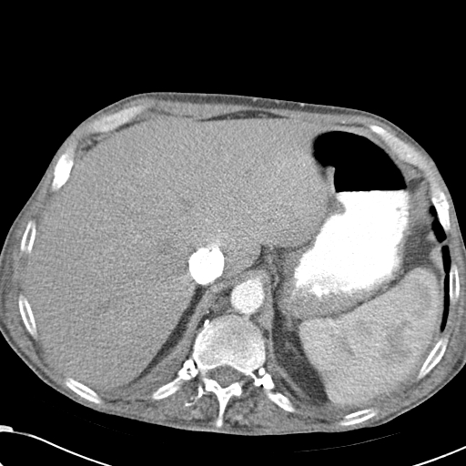 File:Obstructive superior vena cava tumor thrombus (Radiopaedia 28046-28306 A 51).jpg
