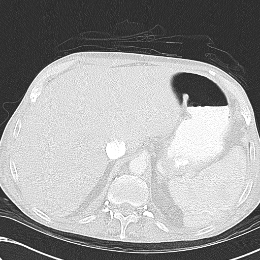 File:Obstructive superior vena cava tumor thrombus (Radiopaedia 28046-28306 Axial lung window 52).jpg