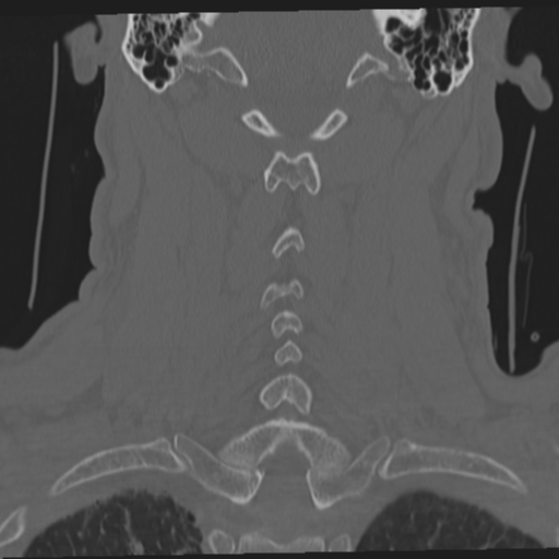 File:Occipital condyle fracture (Radiopaedia 33467-34517 Coronal bone window 45).png