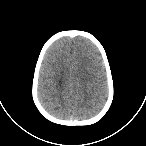 Occipital encephalocele (Radiopaedia 87339-103636 Axial non-contrast 64).jpg