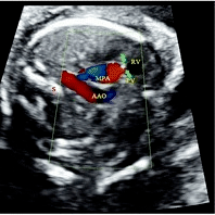 Doppler resolved this problem by visualizing the retrograde flow in the MPA , indicating pulmonary valve atresia