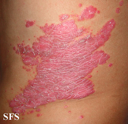 File:Psoriasis (Dermatology Atlas 26).jpg