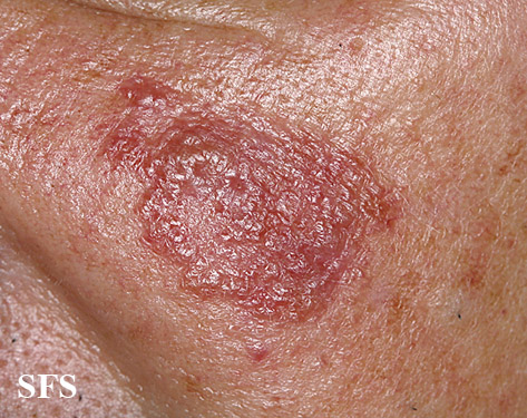 File:Sarcoidosis (Dermatology Atlas 19).jpg