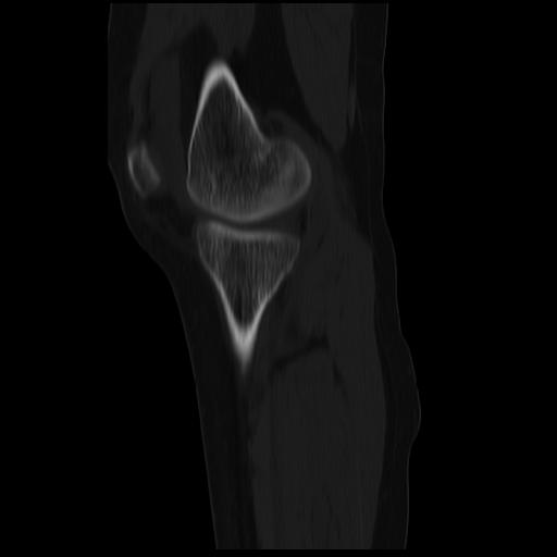 File:ACL avulsion fracture (Radiopaedia 33833-34994 Sagittal bone window 31).jpg