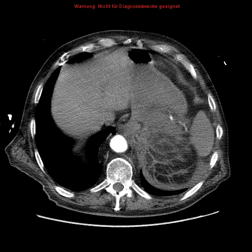 Abdominal aortic aneurysm- extremely large, ruptured (Radiopaedia 19882-19921 Axial C+ arterial phase 10).jpg
