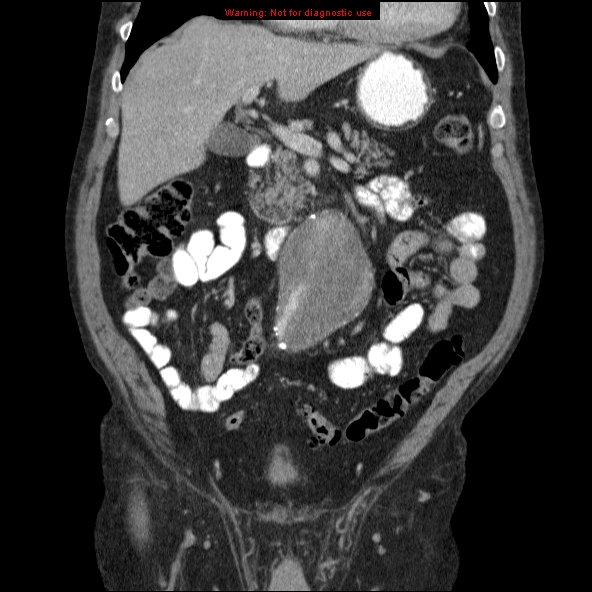 File:Abdominal aortic aneurysm (Radiopaedia 10122-10660 Coronal C+ portal venous phase 11).jpg