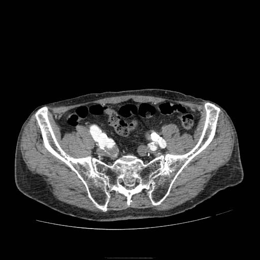 Abdominal aortic aneurysm (Radiopaedia 13341-13340 Axial C+ arterial phase 191).jpg