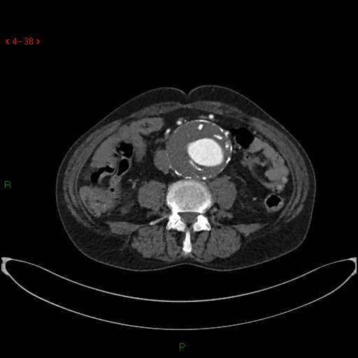 File:Abdominal aortic aneurysm (Radiopaedia 16155-15834 Axial C+ arterial phase 18).jpg