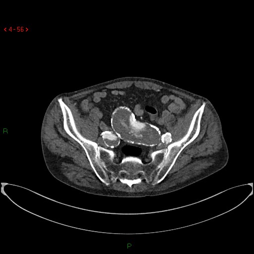 File:Abdominal aortic aneurysm (Radiopaedia 16155-15834 Axial C+ arterial phase 36).jpg