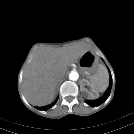 File:Abdominal aortic aneurysm (Radiopaedia 20827-20742 Axial C+ arterial phase 8).jpg