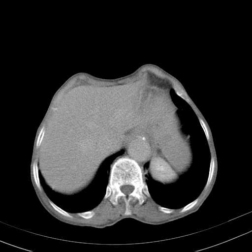 File:Abdominal aortic aneurysm (Radiopaedia 20827-20742 Axial C+ delayed 3).jpg
