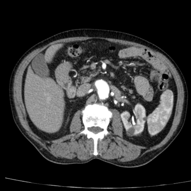 Abdominal aortic aneurysm (Radiopaedia 29248-29660 Axial C+ arterial phase 33).jpg