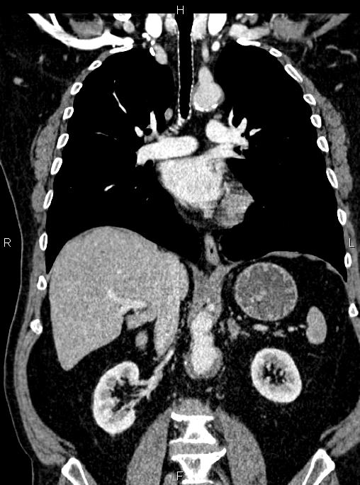 Abdominal aortic aneurysm (Radiopaedia 83094-97462 Coronal renal cortical phase 52).jpg