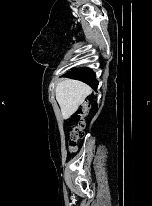 Abdominal aortic aneurysm (Radiopaedia 85063-100606 Sagittal C+ arterial phase 8).jpg