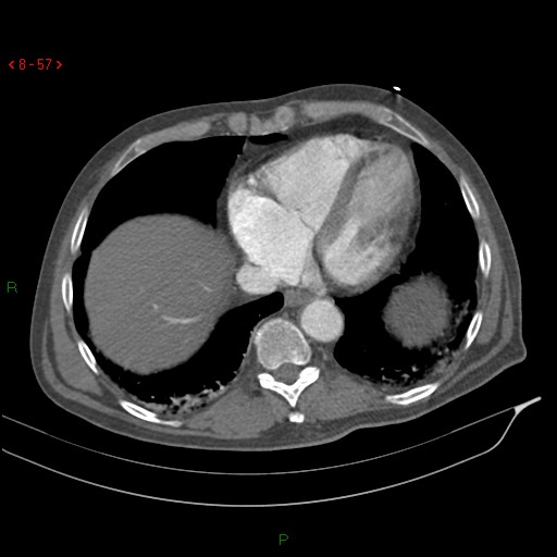 Abdominal aortic aneurysm rupture with aortocaval fistula (Radiopaedia 14897-14841 Axial C+ arterial phase 57).jpg