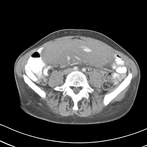 File:Abdominal desmoid tumor (Radiopaedia 41007-43740 Axial C+ portal venous phase 43).png