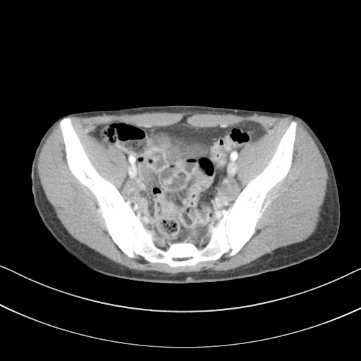 Abdominal multi-trauma - devascularised kidney and liver, spleen and pancreatic lacerations (Radiopaedia 34984-36486 Axial C+ portal venous phase 67).png
