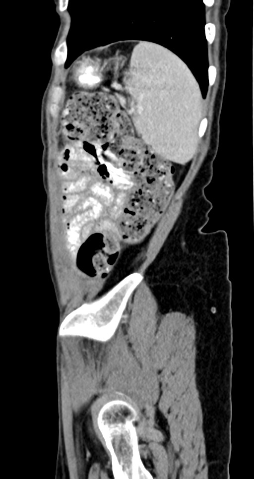 Abdominal wall and retroperitoneal tuberculosis (Radiopaedia 88137-104729 Sagittal C+ portal venous phase 29).jpg