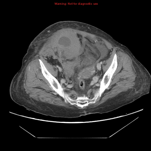 File:Abdominal wall hematoma (Radiopaedia 9427-10112 Axial C+ portal venous phase 89).jpg