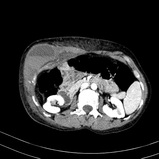 Abdominal wall hematoma with active bleeding (Radiopaedia 83915-99117 Axial renal cortical phase 26).jpg