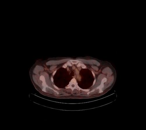 Abdominal wall metastasis from colorectal carcinoma (Radiopaedia 31016-31719 C 121).jpg