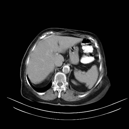 File:Abdominal wall recurrence after colorectal resection for cancer (Radiopaedia 23444-23523 Axial C+ portal venous phase 4).jpg