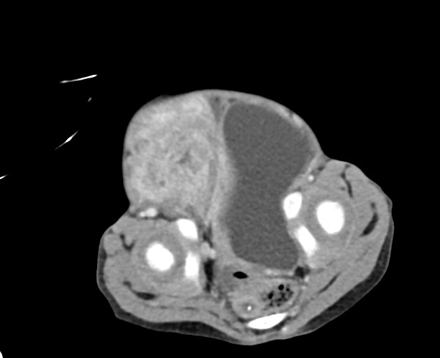 File:Abdominopelvic rhabdomyosarcoma (Radiopaedia 78356-90984 Axial C+ portal venous phase 143).jpg