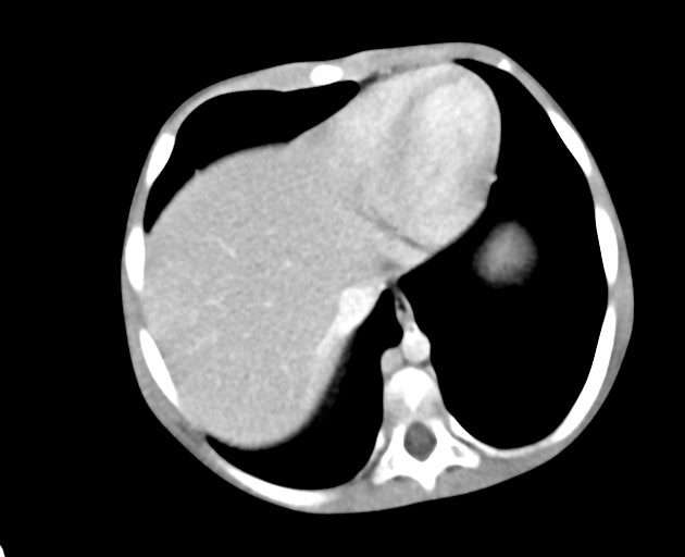 Abdominopelvic rhabdomyosarcoma (Radiopaedia 78356-90984 Axial C+ portal venous phase 37).jpg