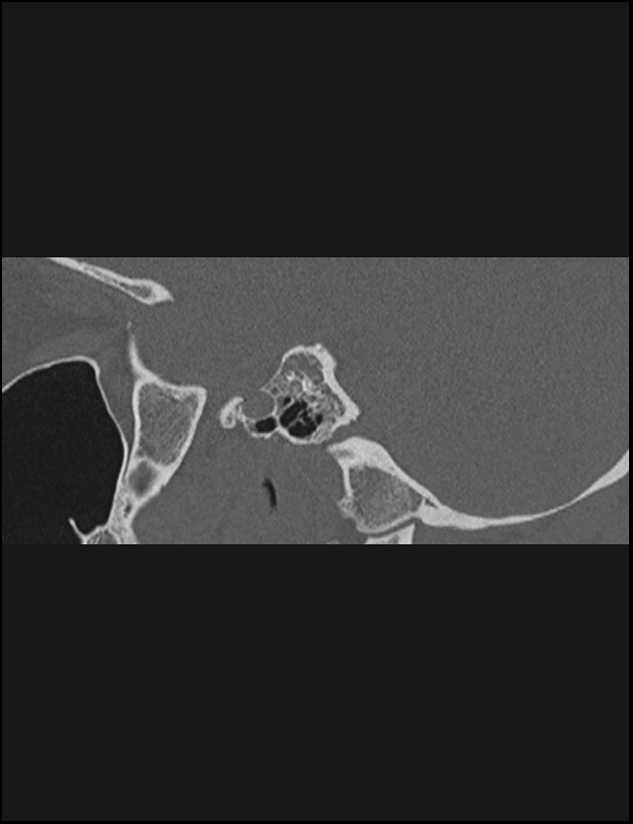 Aberrant right internal carotid artery (Radiopaedia 65191-74198 Sagittal non-contrast 74).jpg