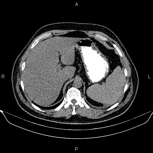 Aberrant right subclavian artery (Radiopaedia 87093-103354 Axial non-contrast 108).jpg