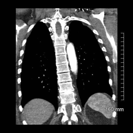 File:Aberrant right subclavian artery stenosis (Radiopaedia 52656-58670 B 65).jpg