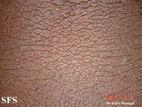 File:Acanthosis Nigricans-Benign (Dermatology Atlas 8).jpg