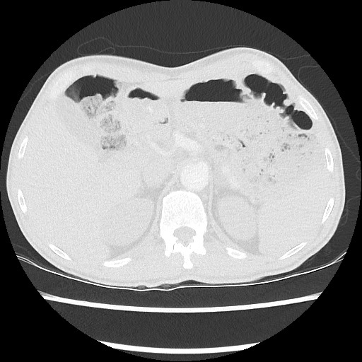 Accessory left horizontal fissure with lingular pneumonia (Radiopaedia 53763-59843 Axial lung window 55).jpg