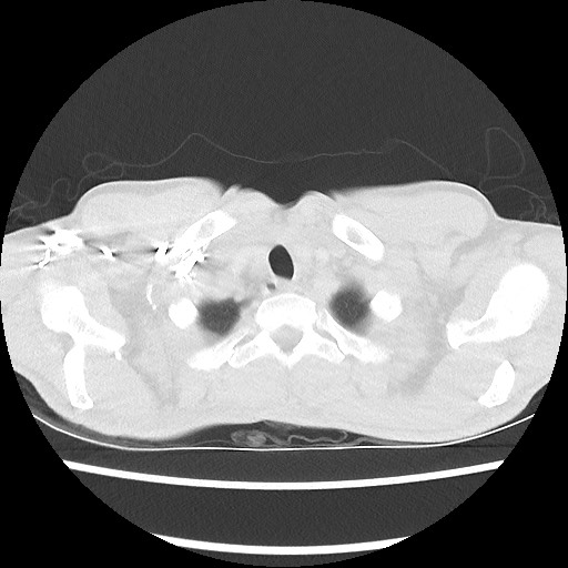 Accessory left horizontal fissure with lingular pneumonia (Radiopaedia 53763-59843 Axial lung window 6).jpg
