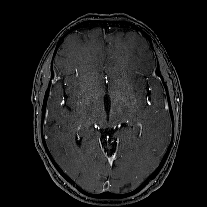Accessory middle cerebral artery (Radiopaedia 73114-83828 Axial MRA 92).jpg