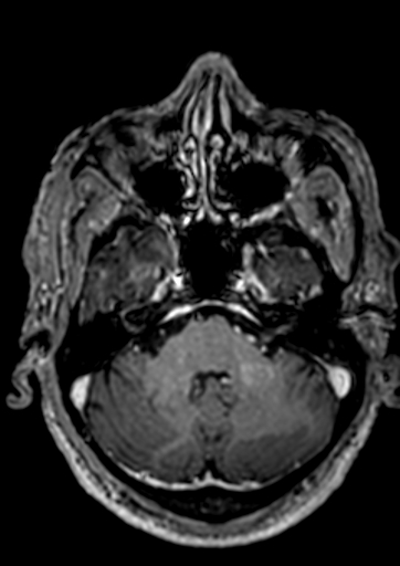 Accessory middle cerebral artery (Radiopaedia 73114-83828 Axial T1 C+ 126).jpg