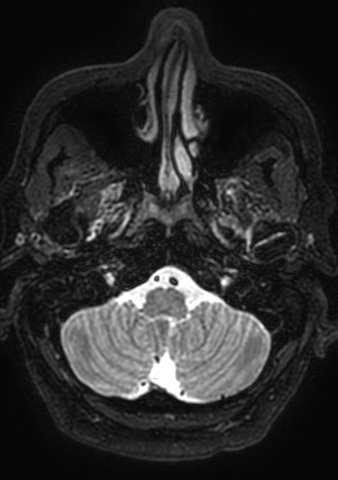 Accessory middle cerebral artery (Radiopaedia 73114-83828 Axial T2 196).jpg