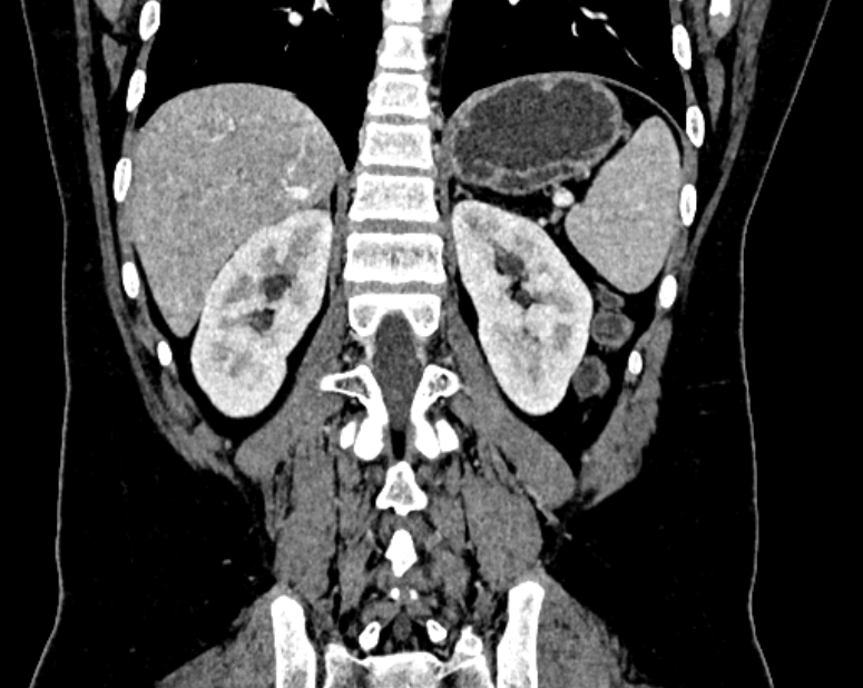 Accessory right inferior hepatic vein (Radiopaedia 75207-86305 Coronal C+ portal venous phase 55).jpg