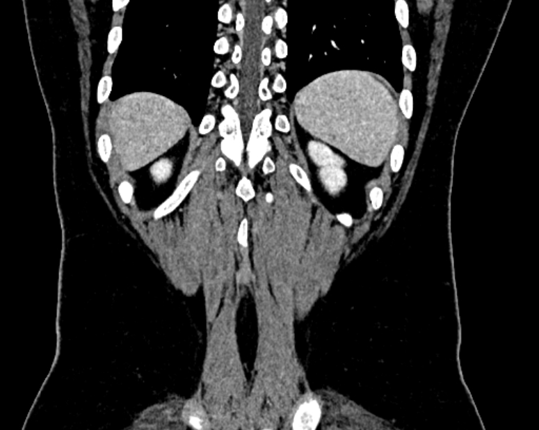 Accessory right inferior hepatic vein (Radiopaedia 75207-86305 Coronal C+ portal venous phase 73).jpg