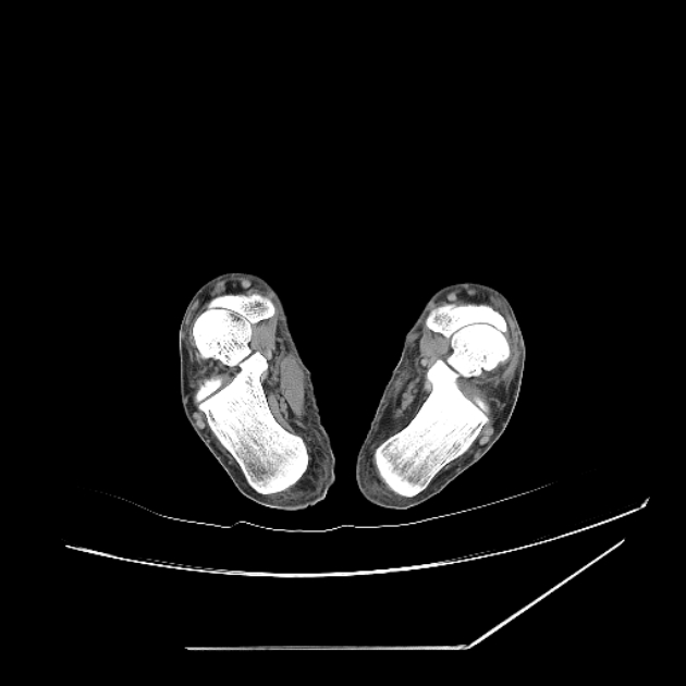 Accessory soleus muscle (Radiopaedia 61069-68943 Axial non-contrast 61).jpg