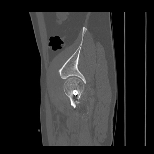 Acetabular and ilial fractures (Radiopaedia 59084-66378 Sagittal bone window 81).jpg