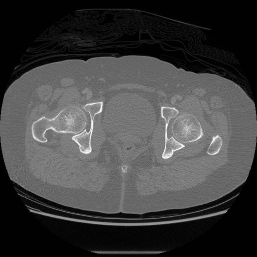 File:Acetabular fracture (Radiopaedia 13193-13212 Axial bone window 35).jpg