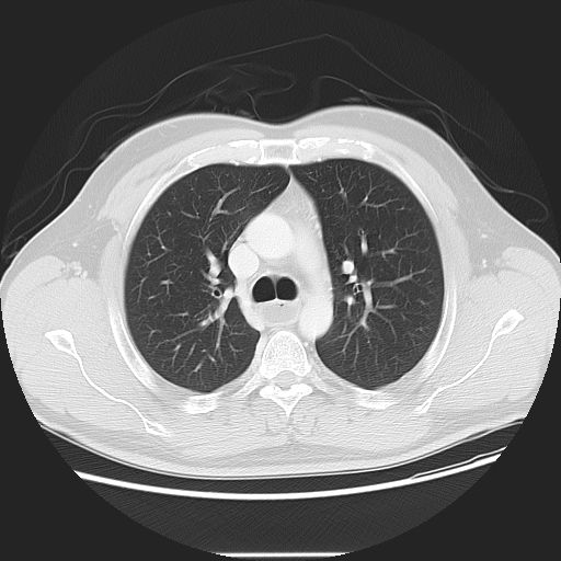 Achalasia (Radiopaedia 8831-9629 Axial lung window 24).jpg