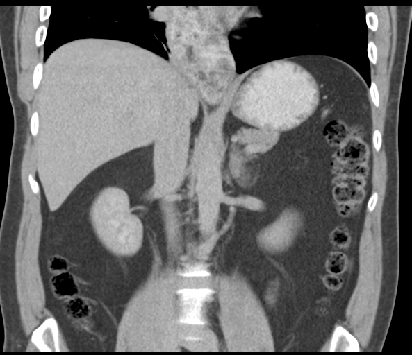 File:Achalasia of the cardia (Radiopaedia 38497-40595 Coronal C+ portal venous phase 29).png