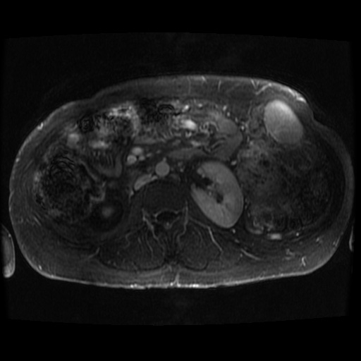 Acinar cell carcinoma of the pancreas (Radiopaedia 75442-86668 Axial T1 C+ fat sat 20).jpg