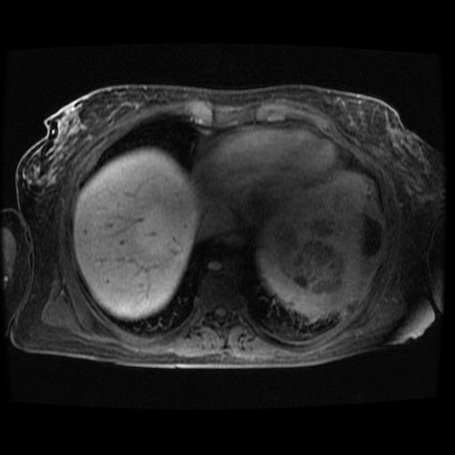 Acinar cell carcinoma of the pancreas (Radiopaedia 75442-86668 Axial late phase (~30 mins) 132).jpg