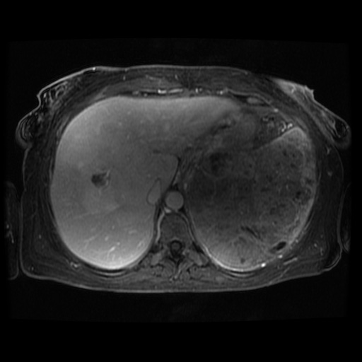 Acinar cell carcinoma of the pancreas (Radiopaedia 75442-86668 D 109).jpg