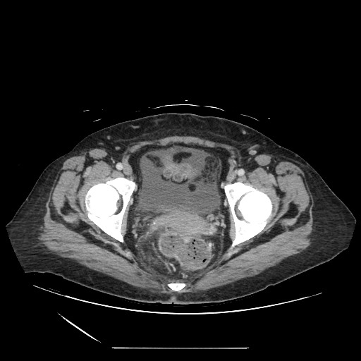 Acinar cell carcinoma of the pancreas (Radiopaedia 75442-86669 Axial C+ portal venous phase 136).jpg
