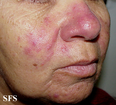 File:Acne Rosacea (Dermatology Atlas 15).jpg