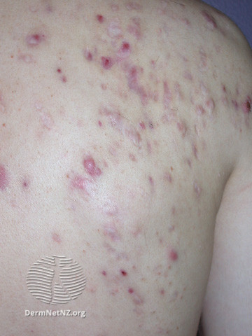 File:Acne affecting the back images (DermNet NZ acne-acne-back-167).jpg